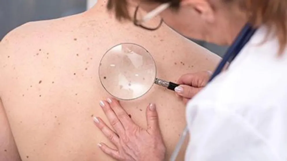 Campaña contra el Cáncer de Piel: afirman que la exposición al sol es un factor de riesgo