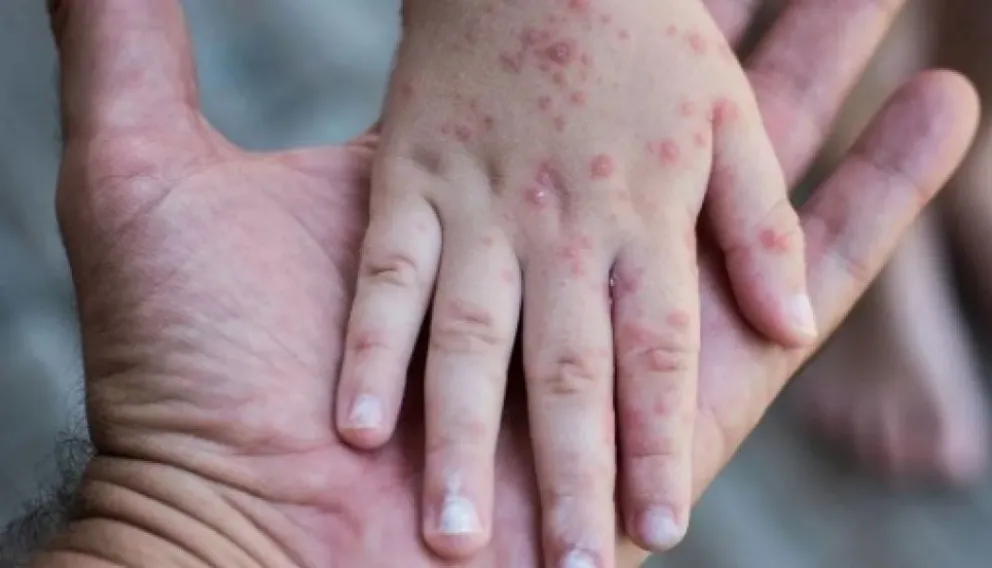 Alerta epidemiológica: aumentaron los casos de sarampión en Argentina