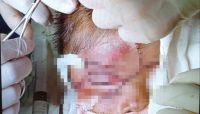 Una niña fue atropellada y debieron reconstruir su rostro: su familia pide el traslado urgente a Salta